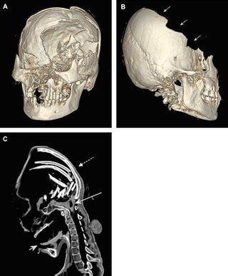 ct scan of bludgeoned mummy woman's skull