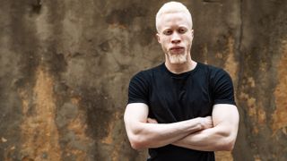 An African American man with albinism.