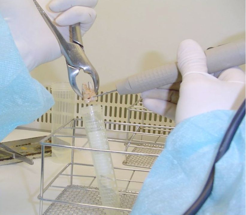 A researcher collects a sample from an ancient human tooth in search of the bacteria that cause cavities and tooth decay.