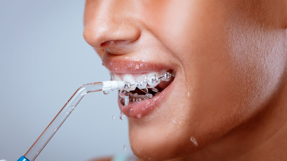 Woman with braces using a water flosser