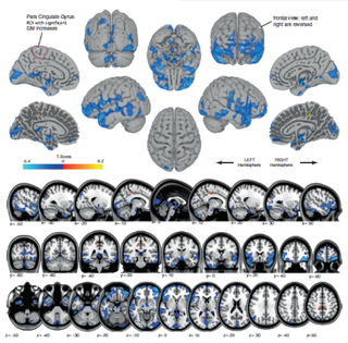 These MRI scans are the first images ever to show how spaceflight changes brain structure in humans. Blue shows areas of gray-matter volume decrease, likely reflecting shifting of cerebrospinal fluid. Orange shows regions of gray-matter volume increase, in the regions that control movement of the legs.