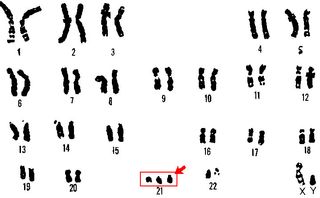 An error in cell division can result in Down syndrome, a condition caused by an extra copy of chromosome 21.