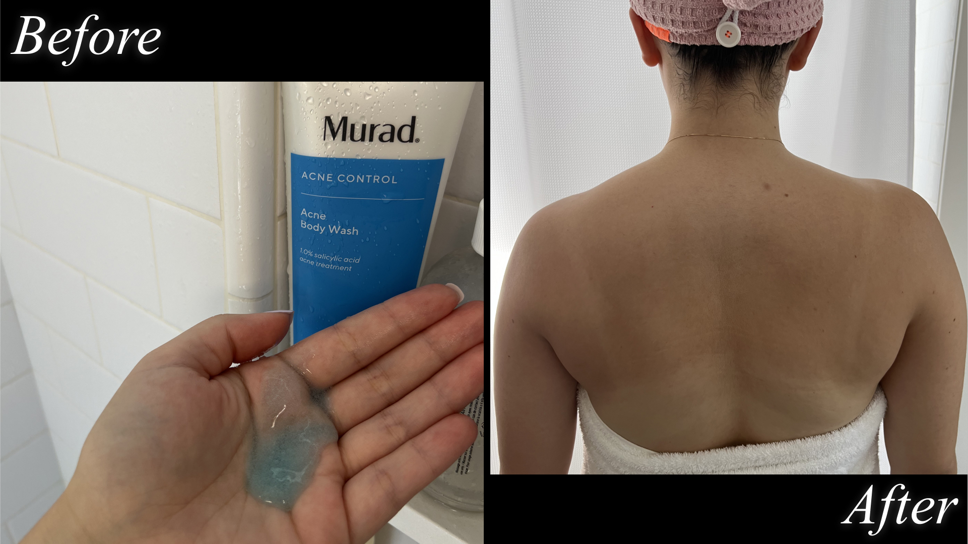 catharine malzahn before and after testing murad acne body wash on her back