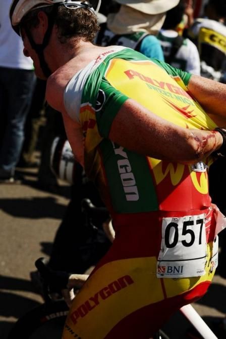 Ryan Sherlock (Polygon Sweet Nice Cycling Team) bears the scars of his Stage 6 crash.