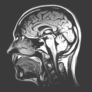 MRI of a human brain, sagittal slice.