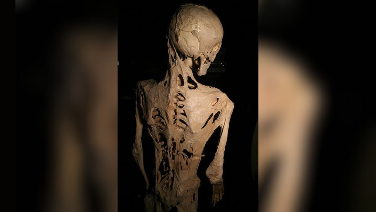 ‘Stone man disease’: A rare condition that causes a person to grow a second skeleton