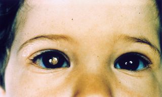 A photo of a child with retinoblastoma, a cancer of the eye that appears as a white glow in photos.