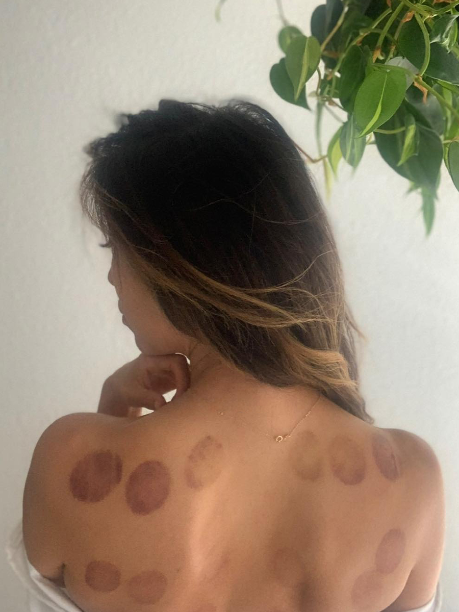 Dr. Debbie Kung cupping photo