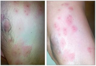 Images of one of the factory worker's rashes. Reproduced with permission from JAMA Dermatology. 2017. 10.1001/jamadermatol.2017.0323.