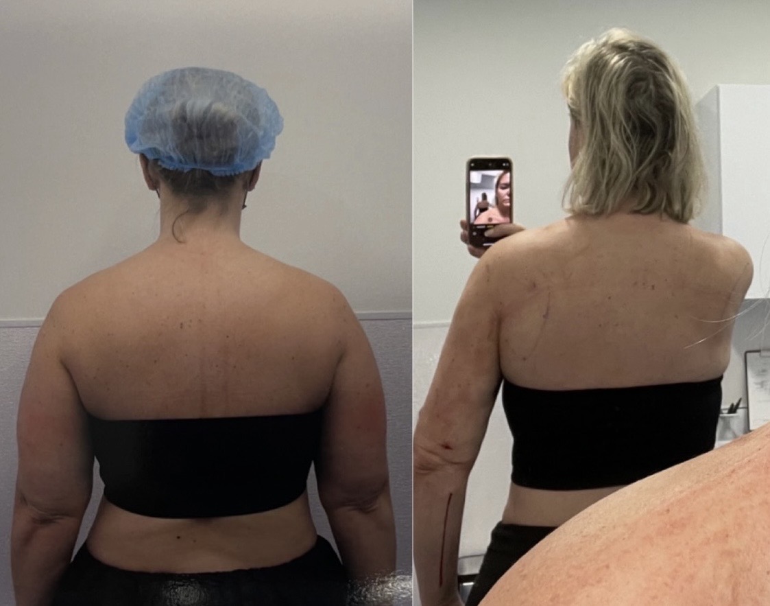 a before and after side by side image of a white woman's back