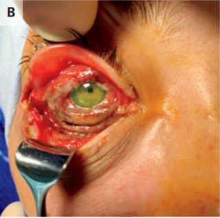 The woman's cowpox infection caused orbital cellulitis, or an infection of the fat and muscles around the eye. She required surgery to remove dead tissue from around her eye.