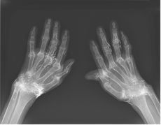 gold thread acupuncture