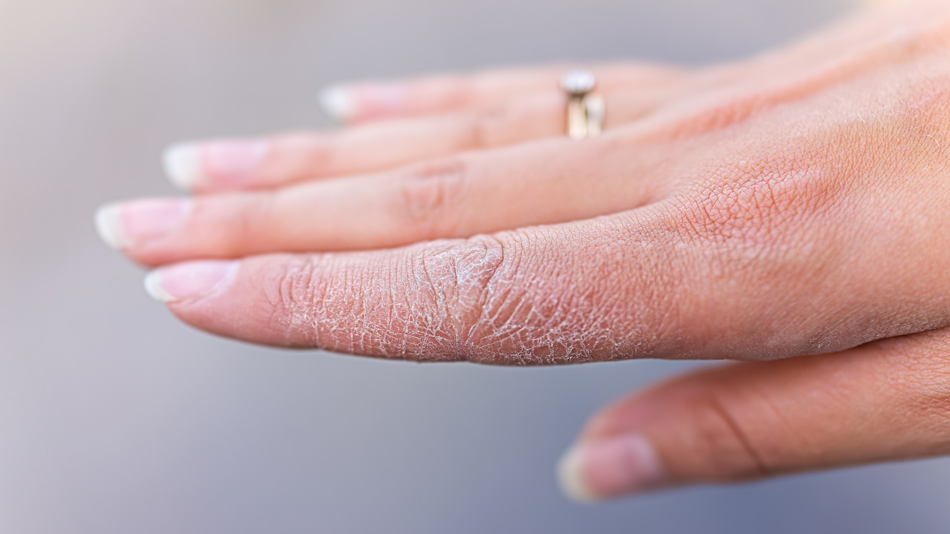Primer plano de la piel seca en la mano de la mujer