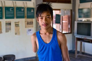 More than 64,000 people have been killed or injured by landmines in Cambodia since 1979. 3D printing significantly lowers the costs of prosthetic hands and arms, helping landmine victims such as this teenage boy in Phnom Phen.