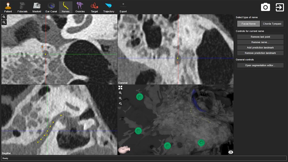 The surgical drilling robot assisted with an operation to implant a hearing device into a deaf woman&#039;s ear.