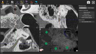 The surgical drilling robot assisted with an operation to implant a hearing device into a deaf woman's ear.