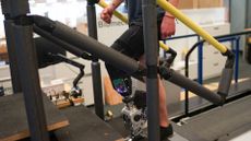 Patient shown walking up stairs while wearing the new prosthetic limb. Only the bottom half, from the middle of their torso downwards is shown.
