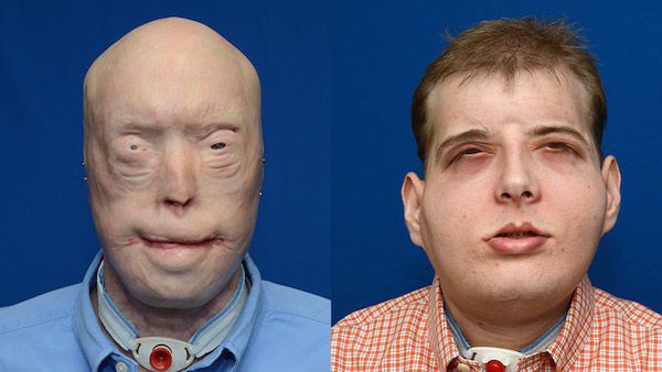 face transplant, facial transplant, before after