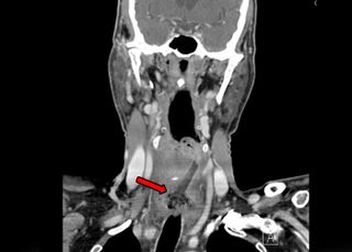 A man ate a Mother's Day cupcake so fast, he accidentally swallowed the 2-inch (5 centimeters) cupcake topper. Above, a CT scan showing the topper stuck in the man's esophagus, as indicated by the red arrow.