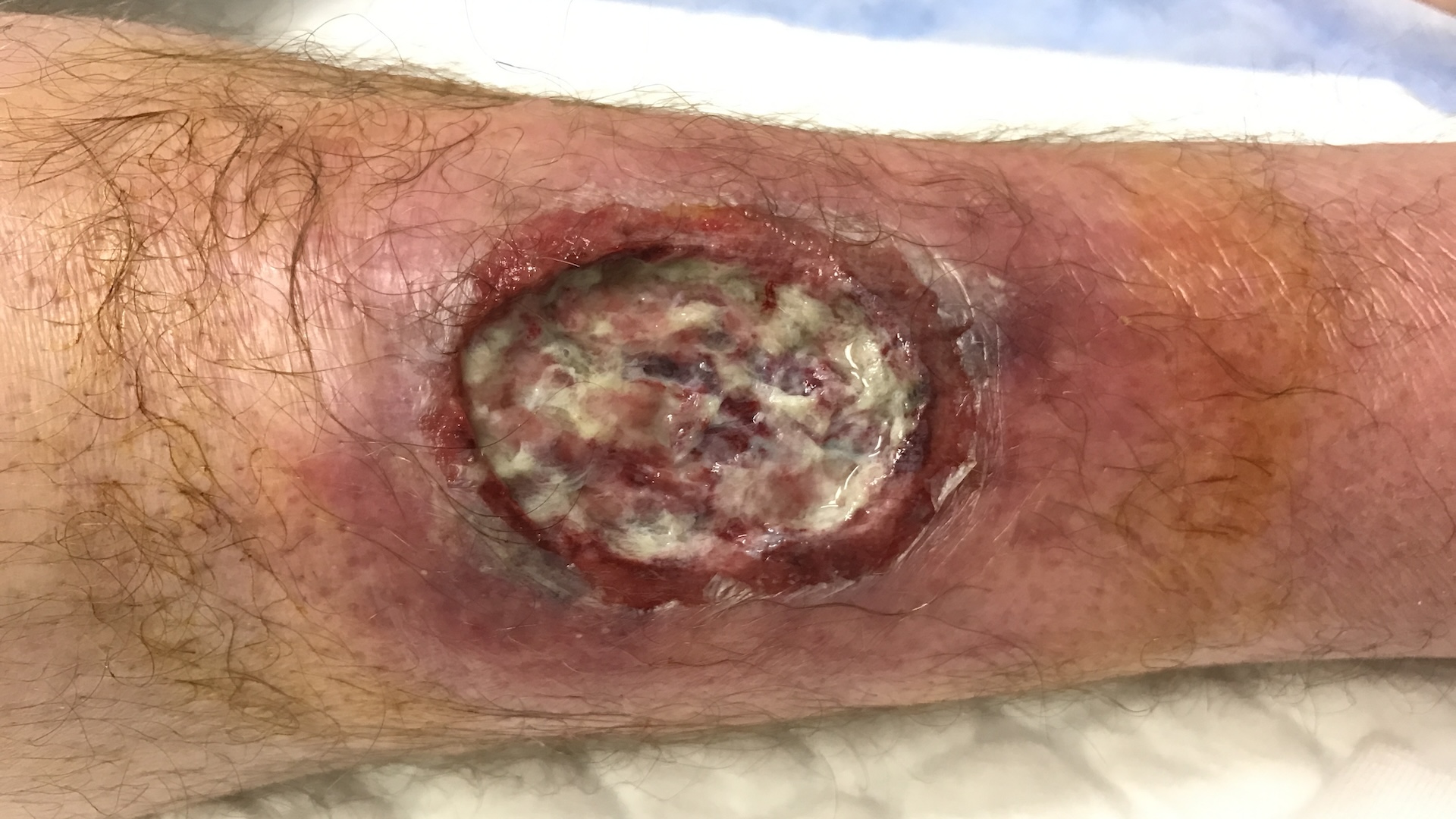 A picture of a circular necrotizing infection on a limb