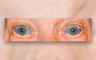 A 70-year-old man went to the doctor because the whites of his eyes, known as the sclera, were turning blue.