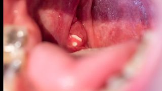A tonsil stone inside a mouth