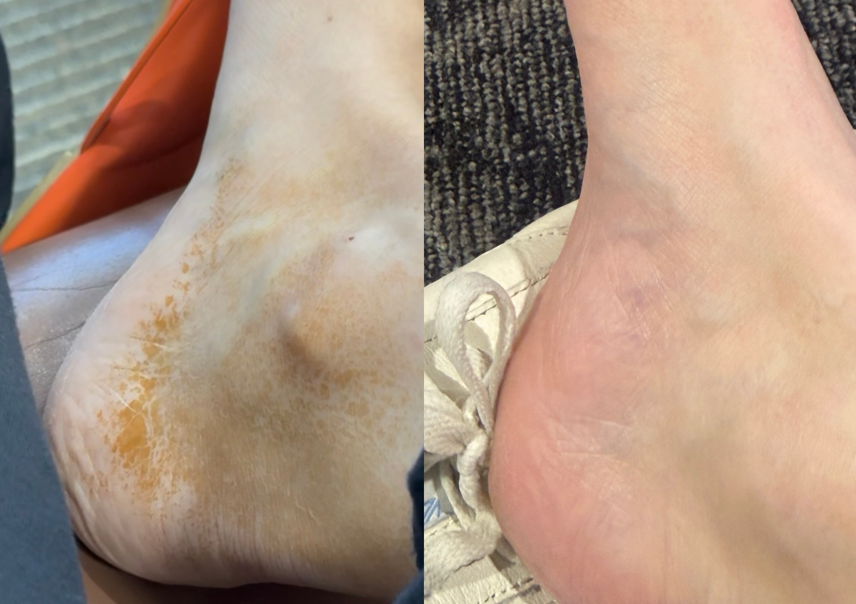 before and after using the coco and eve tan prep and erase scrub on the heel of a foot