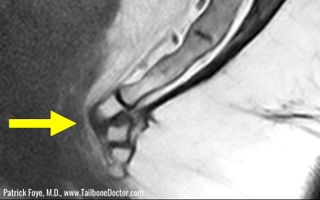 An MRI scan of a dislocated tailbone (though not one from this case series).