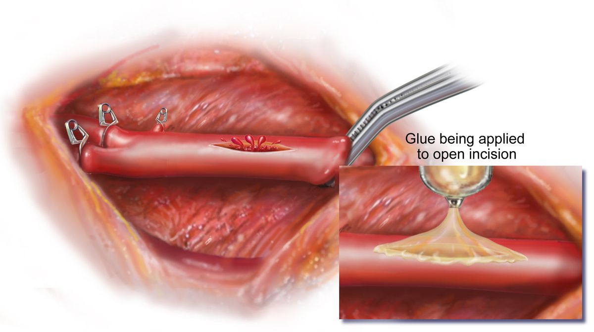 This illustration shows how a torn blood vessel could be sealed back together with a bit of the new glue.