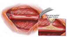 This illustration shows how a torn blood vessel could be sealed back together with a bit of the new glue.