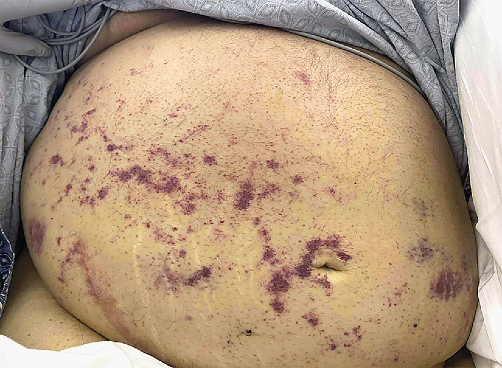 a close-up of a man's belly with a purple rash