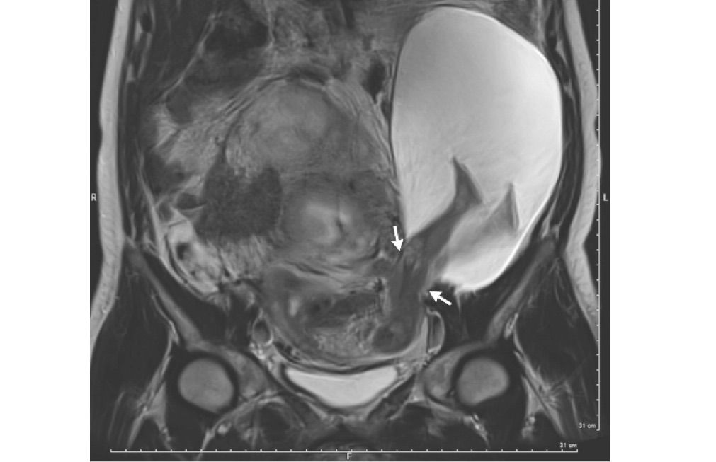 uterine rupture, amniocele, amniotic sac