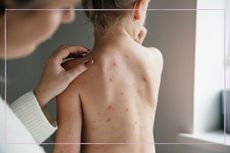 A woman touching the back of a boy with chickenpox