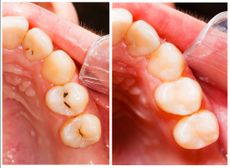 cavities, teeth, health, fillings