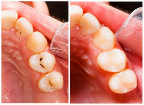 Cavities Tooth Decay Causes Symptoms Treatment Live Science