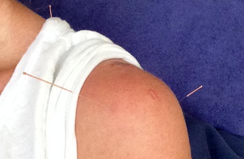 Acupuncture with Ged
