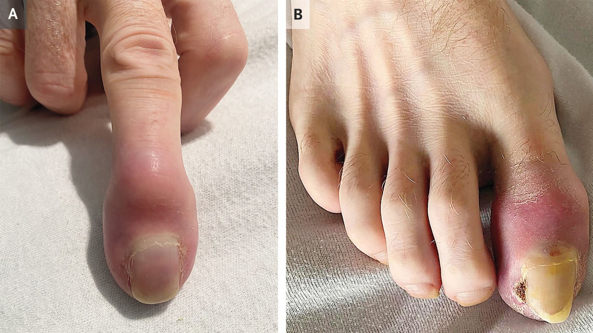 two photos, one of a man's swollen finger tip and the other of his swollen toe