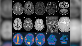 A composite image of three rows of brain scans. The scans on the top two rows are in greyscale, while those in the bottom row are multi-colored. An enlarged, blurred version of the image is behind.