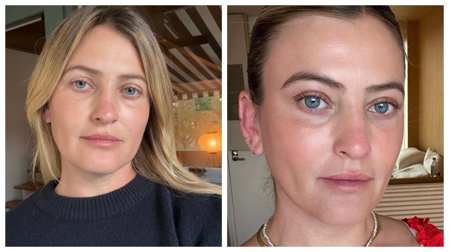 Aviel Kanter before and after brow lift surgery