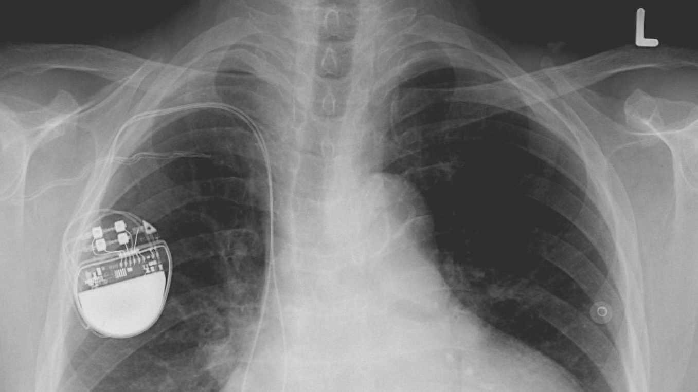 Life-saving Pacemakers Could Be Hacked With Malware 