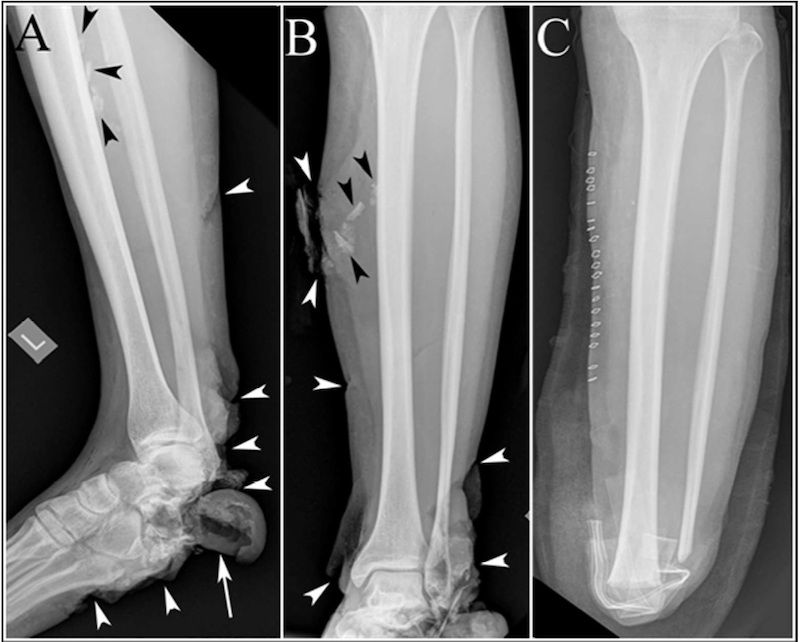 Boston Marathon Bombing: X-Rays And CT Scans Reveal Injuries, Lessons ...