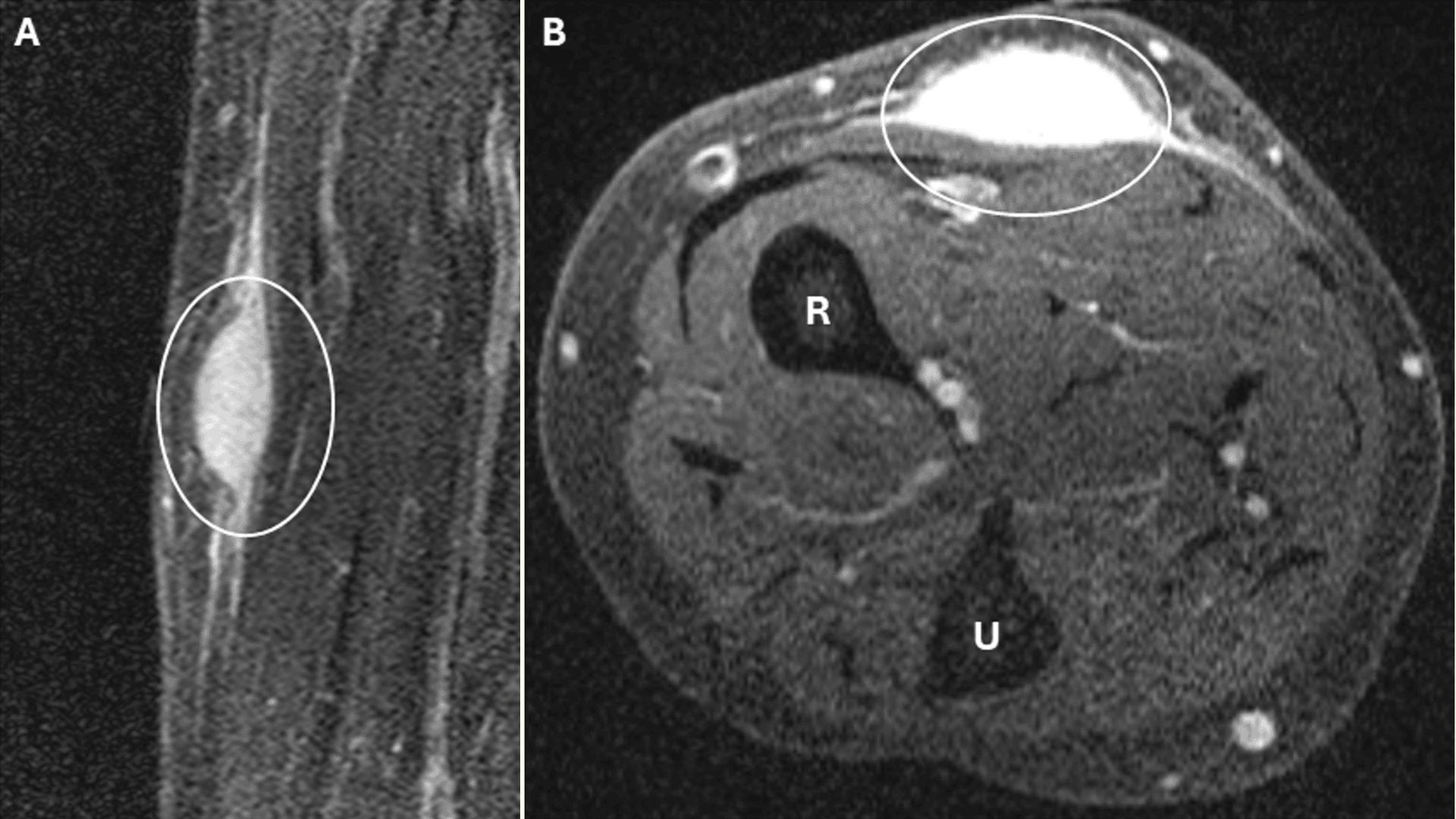two MRIs show an arm from two different angles, each with a circle around a bright white, oval-shaped mass