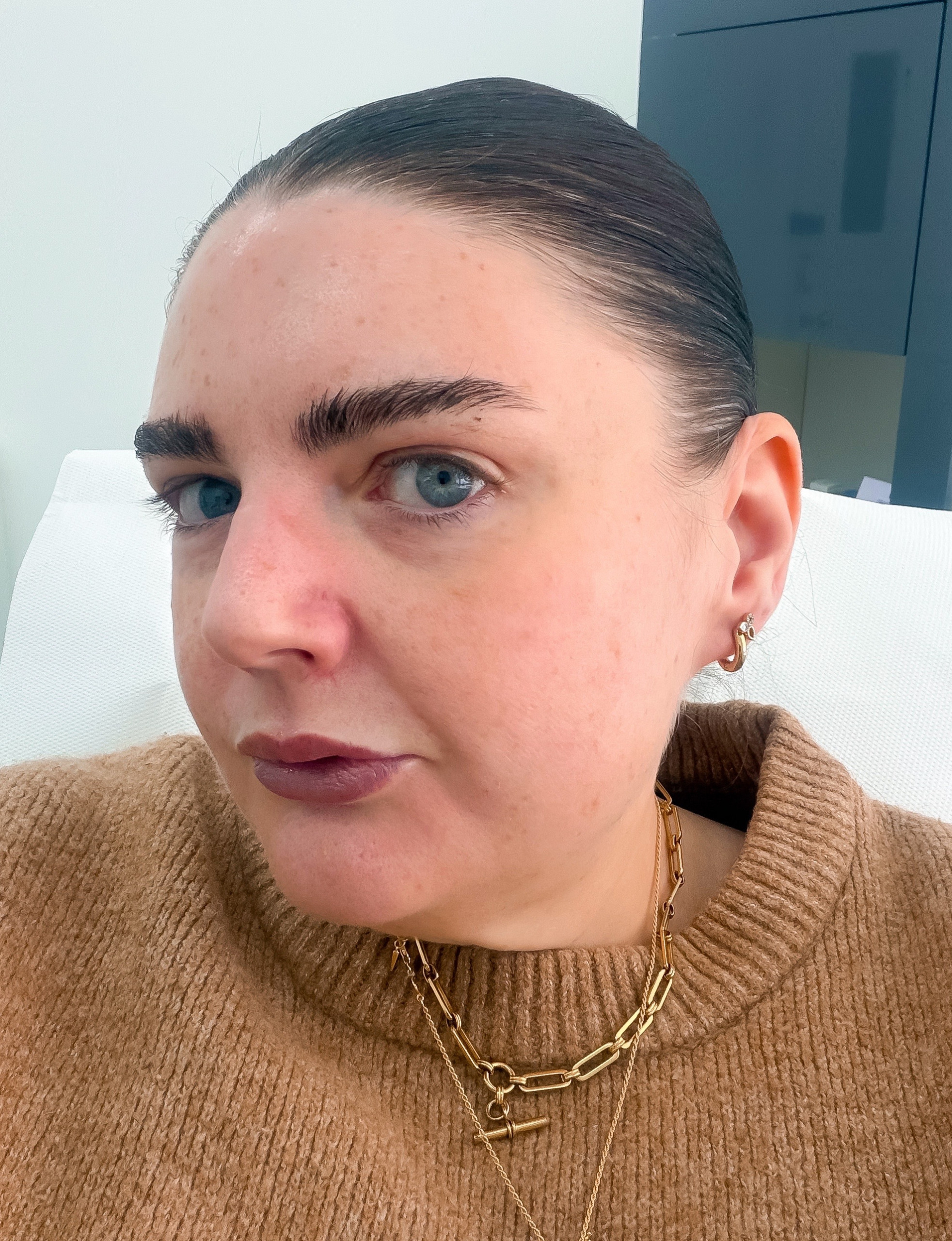 SKINVIVE&amp;trade; and HArmonyCa&amp;trade; before image