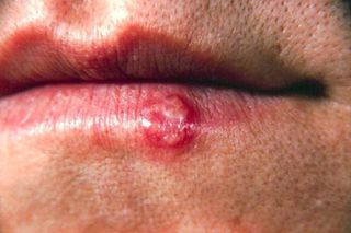 A cold sore on this patient’s lip was caused by the herpes simplex virus type 1 (HSV-1).