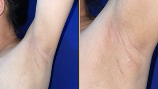 Photograph under the left armpit of a woman. The right image is zoomed in to the droplet of milky secretion.