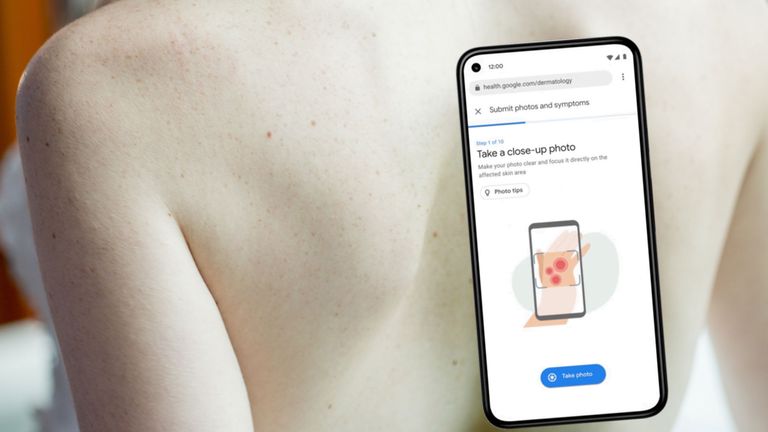 Google AI dermatology tool