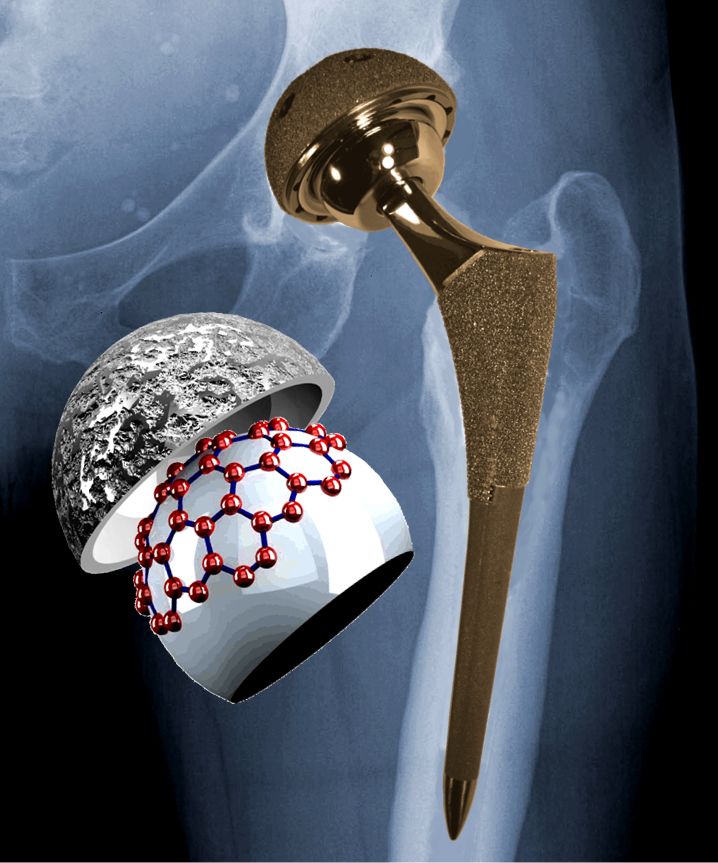 an X-ray of the hip region with a metal-on-metal implant superimposed and a schematic illustrating graphitic material on the surface of the implant. The red spheres represent the positions of the carbon atoms in a single layer of graphite.