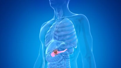 Illustration of pancreatic cancer in a human body.