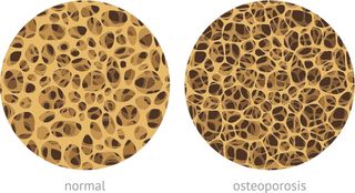 Osteoporosis bones are porous and weak compared to healthy bones that are more dense.