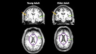 Brain images from a 35-year-old and an 85-year-old. Orange arrows show the thinner gray matter in the older individual. Green arrows point to areas where there is more space filled with cerebrospinal fluid (CSF) due to reduced brain volume. The purple circles highlight the brains’ ventricles, which are filled with CSF. In older adults, these fluid-filled areas are much larger.